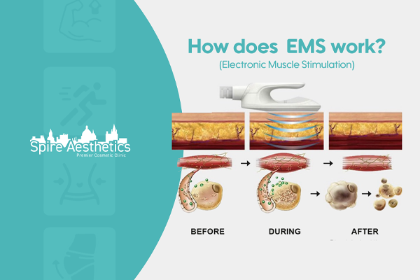 EMS treatment for post pregnancy weight loss treatment Banstead