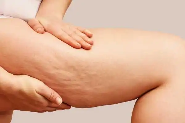 Image of woman showing leg with cellulite Banstead