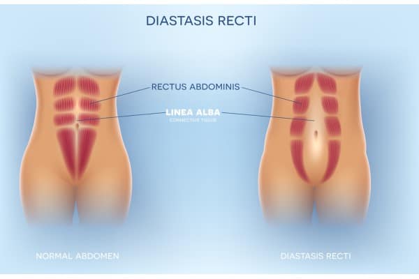 What Non-Surgical Options Are Available for Diastasis Recti Banstead?