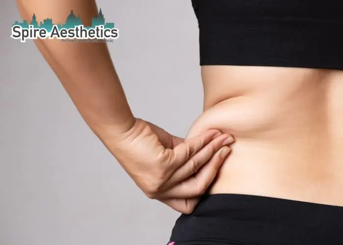 Image of woman pinching fat on their hips Banstead. Fat Freezing treatment 