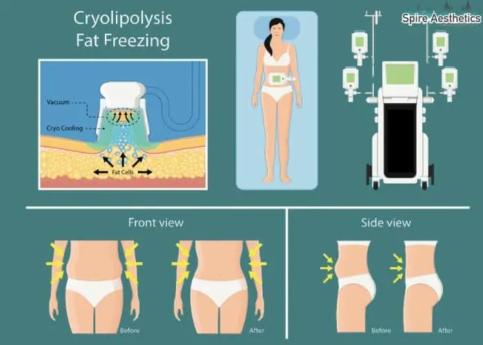 Fat freezing treatment Banstead benefits for competitions to remove stubborn fat deposits.