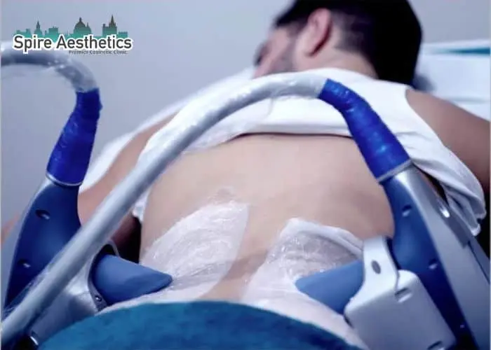 Man having fat freezing treatment done on love handles before a competitions Banstead to create a sculpted look.