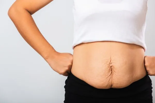 Image of a woman's stomach after weight loss with sagging skin following a gastric band Banstead