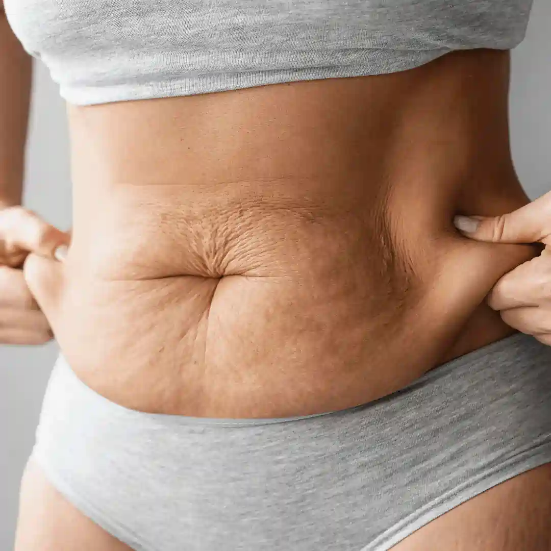 Is It Normal to Have Loose Skin After Pregnancy Banstead?