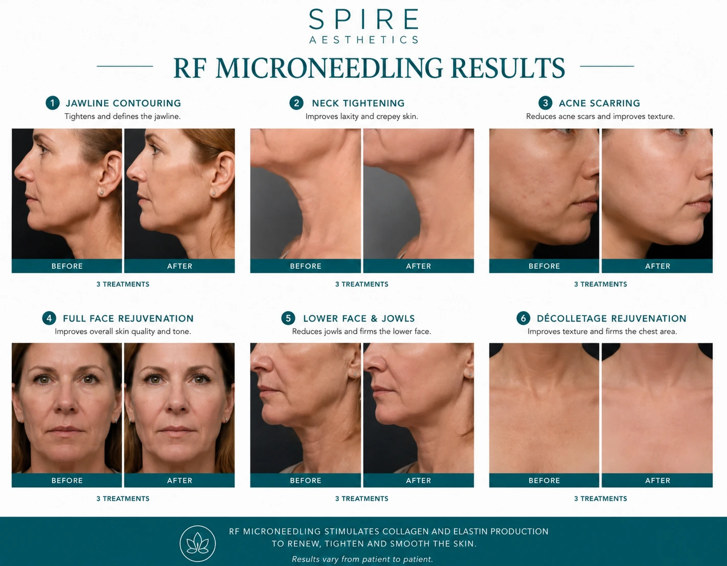 RF Microneedling Skin tightening Banstead results