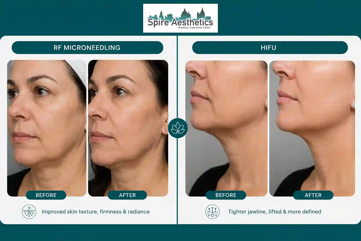 Can RF Microneedling and HIFU Be Combined Banstead?