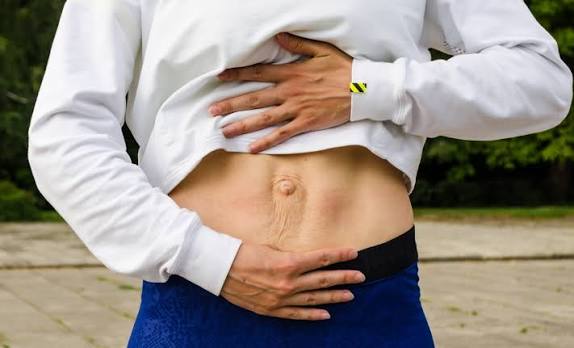When Could Diastasis Recti Be the Missing Piece of the Puzzle Banstead?