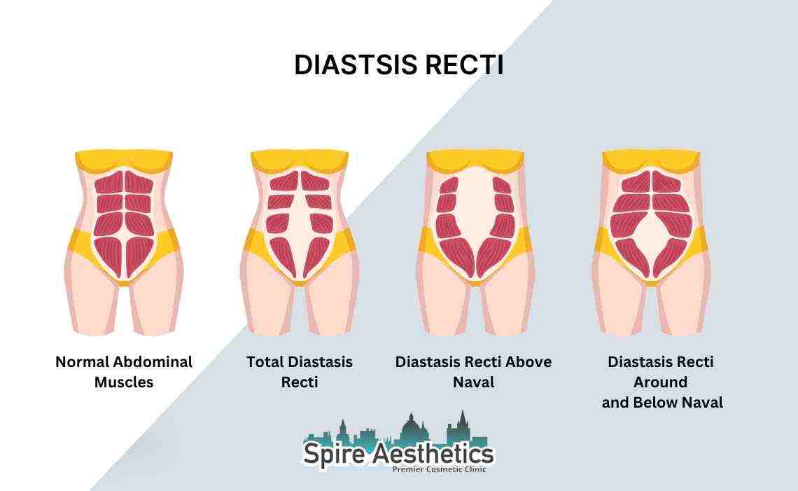 Is Non-Surgical Diastasis Recti Treatment Right for You? Common Concerns Answered Banstead